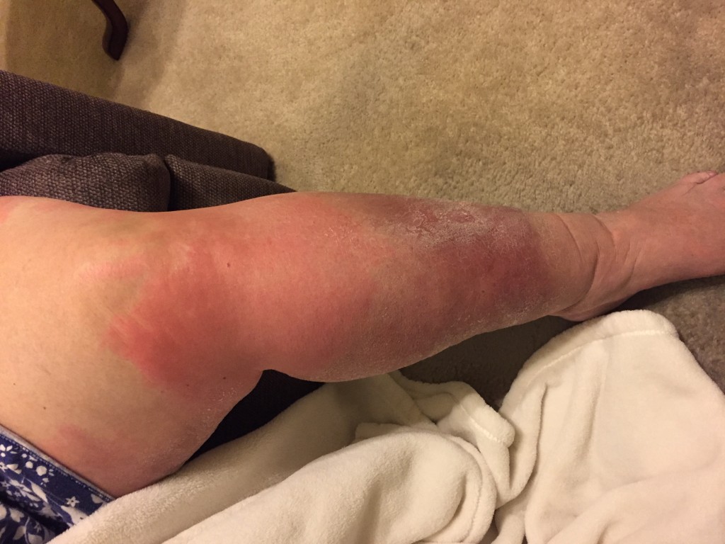 Cellulitis Vibrant Life